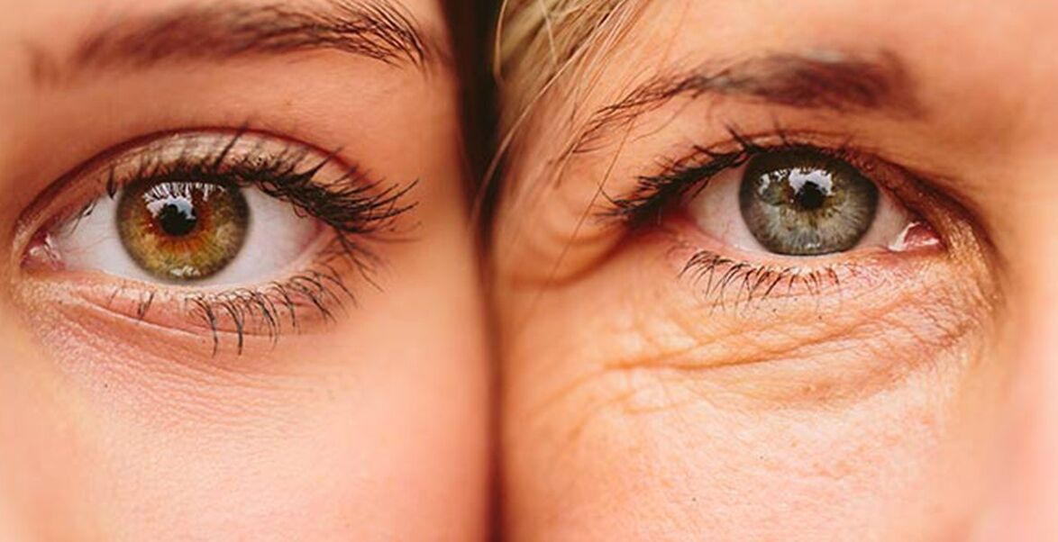 Външни признаци на стареене на кожата около очите при две жени на различна възраст