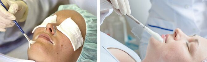 пилинг и криотерапия за подмладяване на кожата
