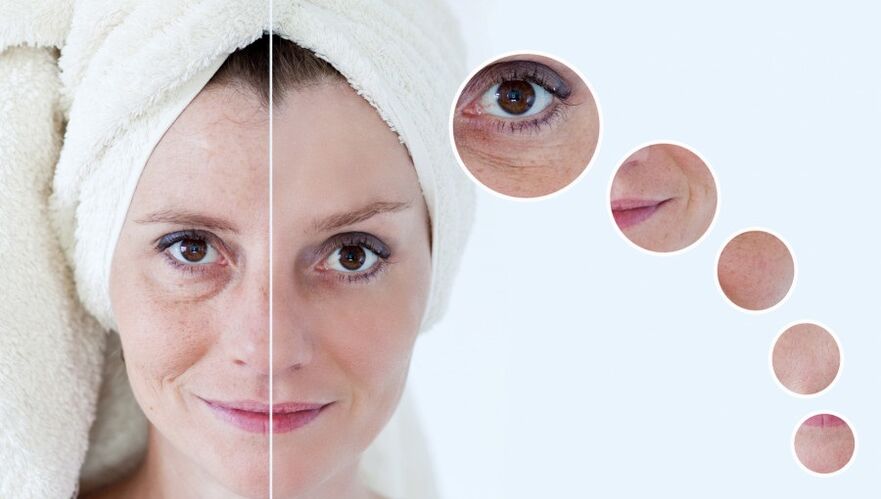 преди и след плазмено подмладяване на кожата