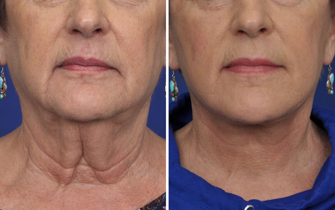 преди и след процедури за подмладяване на кожата