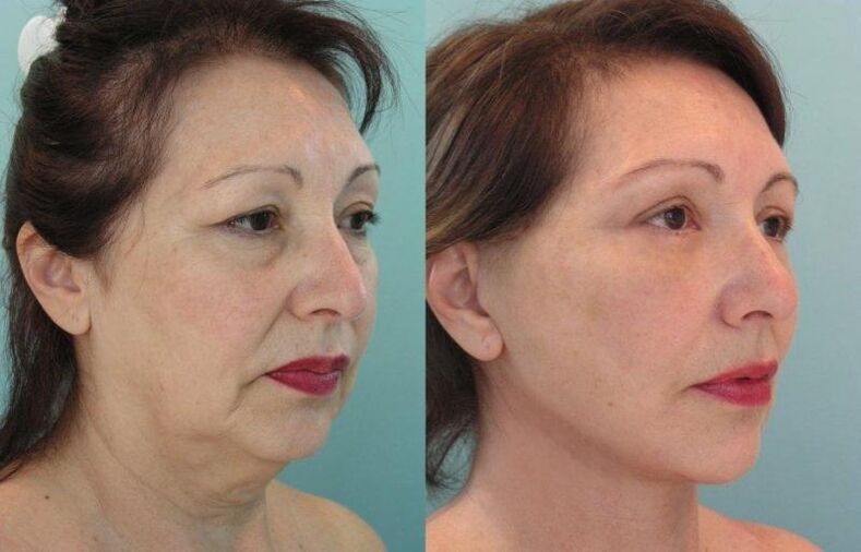 Резултат от подмладяване на кожата на лицето стягане с конци