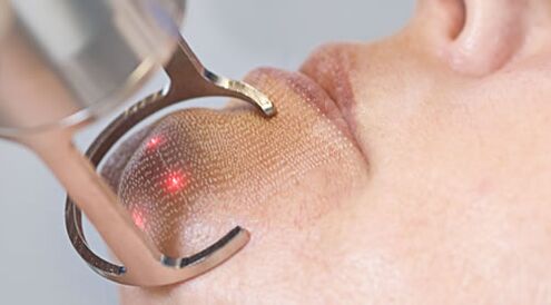 Курсът на процедурата за фракционно лазерно подмладяване на кожата на лицето