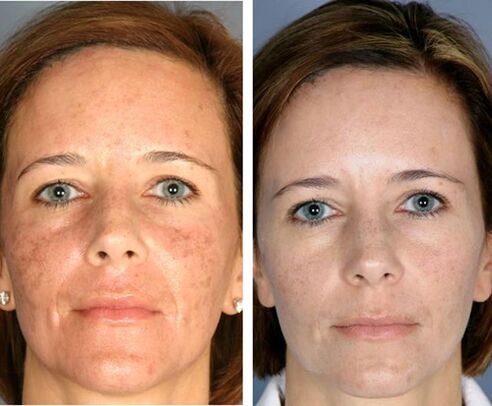 Преди и след фракционна термолиза на лицето