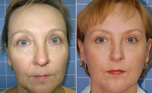 Преди и след фракционно лазерно подмладяване на лицето