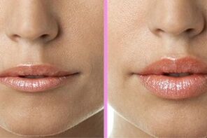 преди и след процедурата за възстановяване на устните